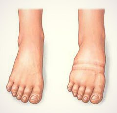 Отеки ног – причины и лечение